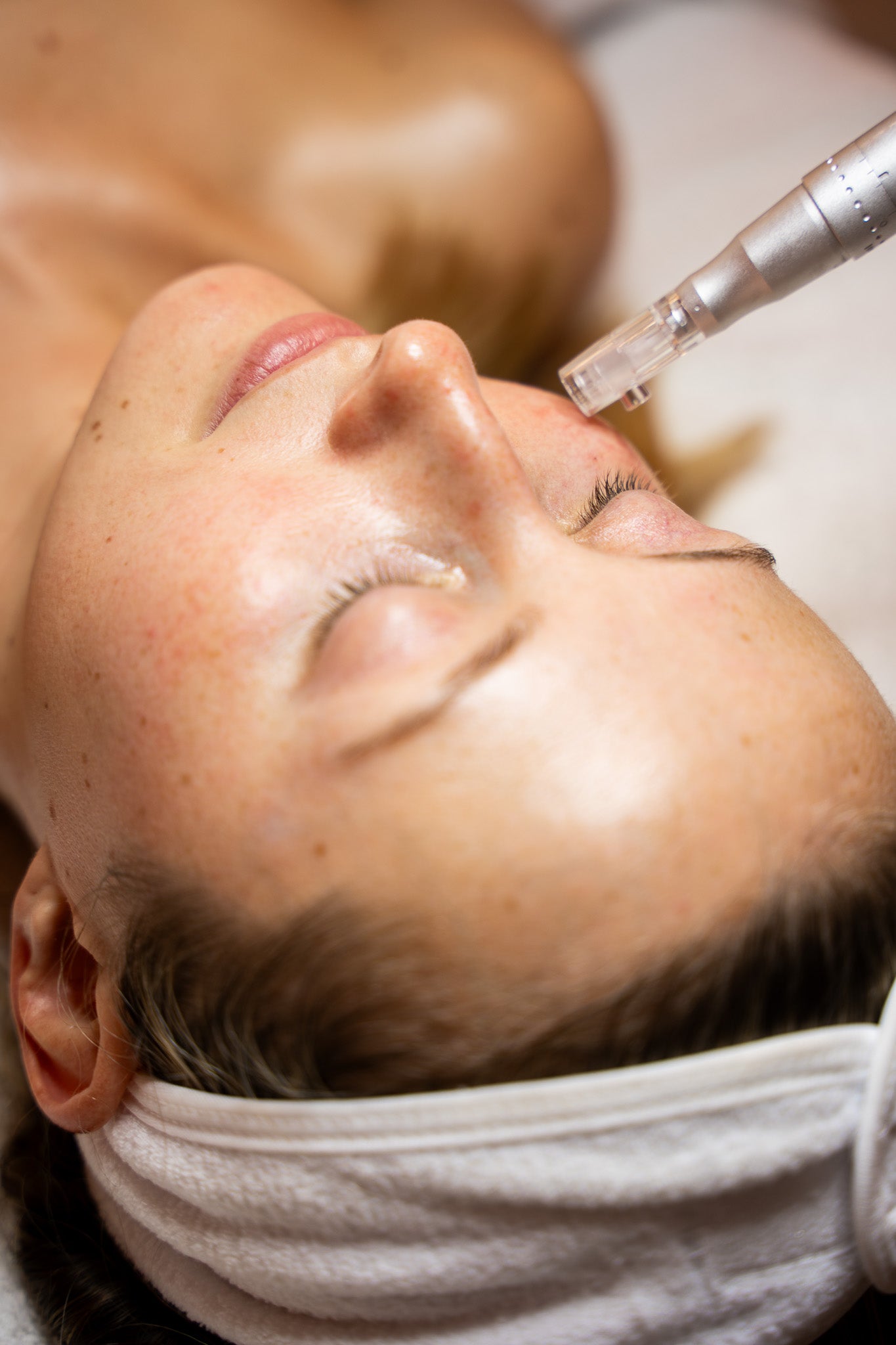 Microneedling with AnteAGE