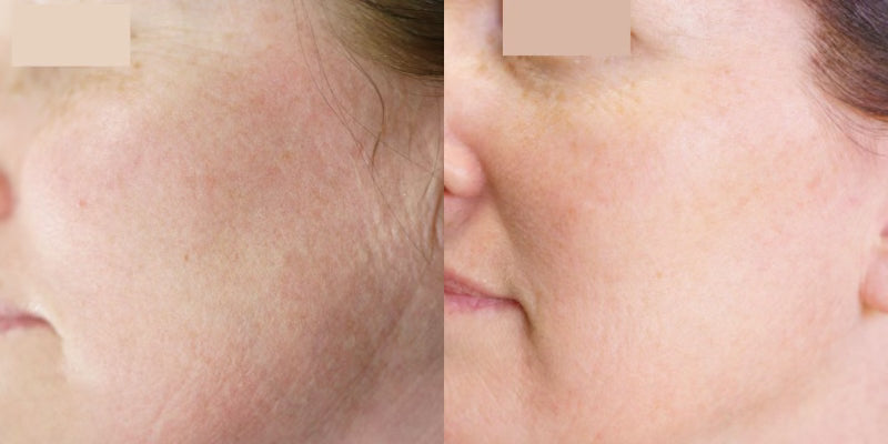 Microneedling with AnteAGE