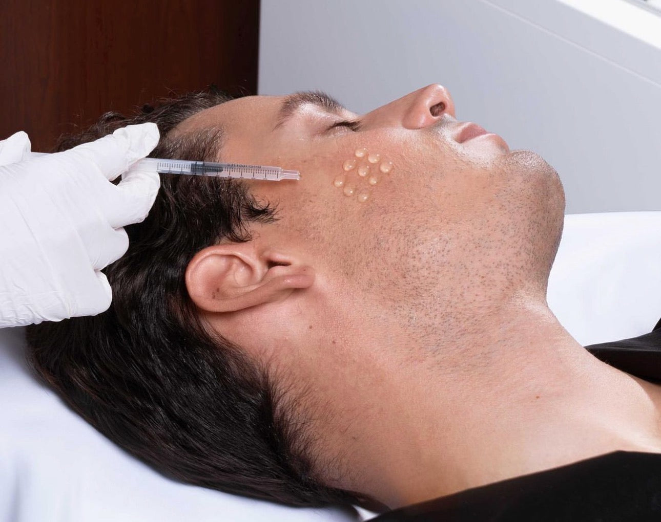 Microneedling with AnteAGE
