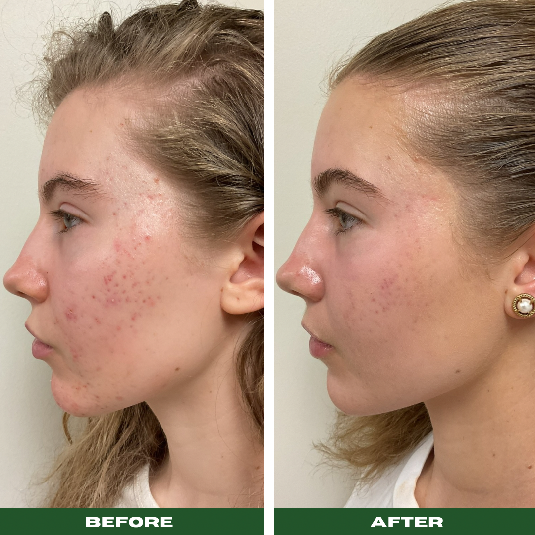Acne Facial