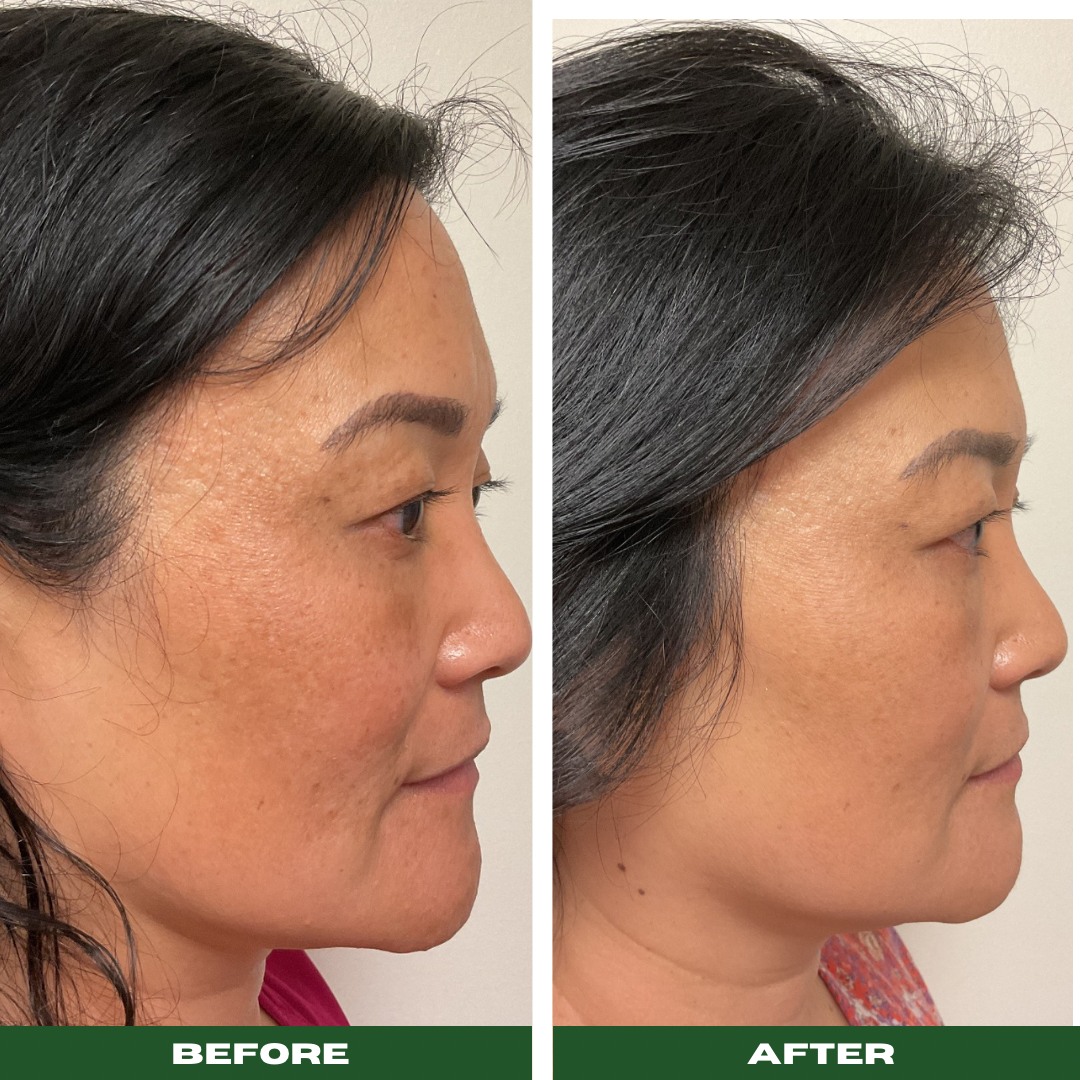 Chemical Peels
