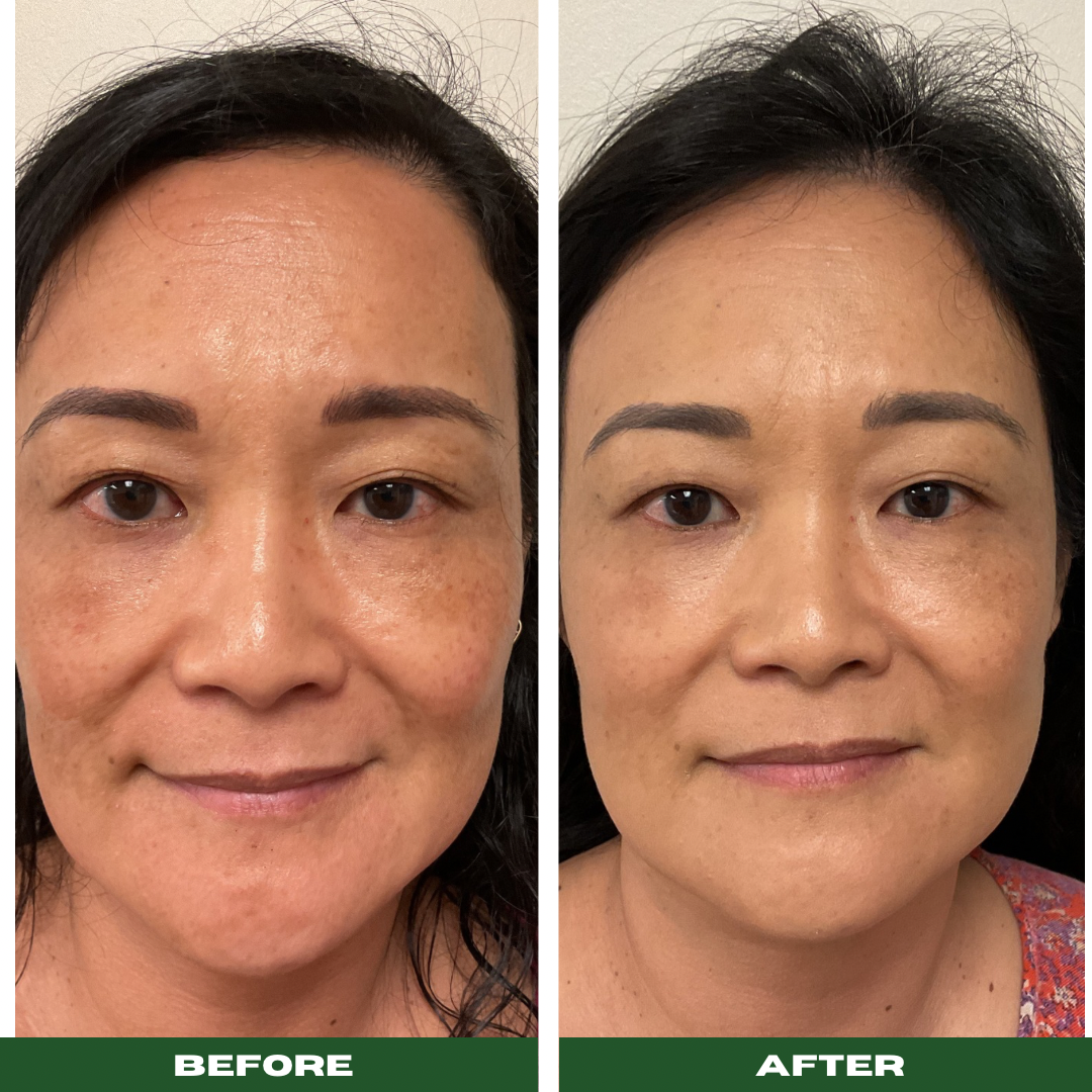Chemical Peels