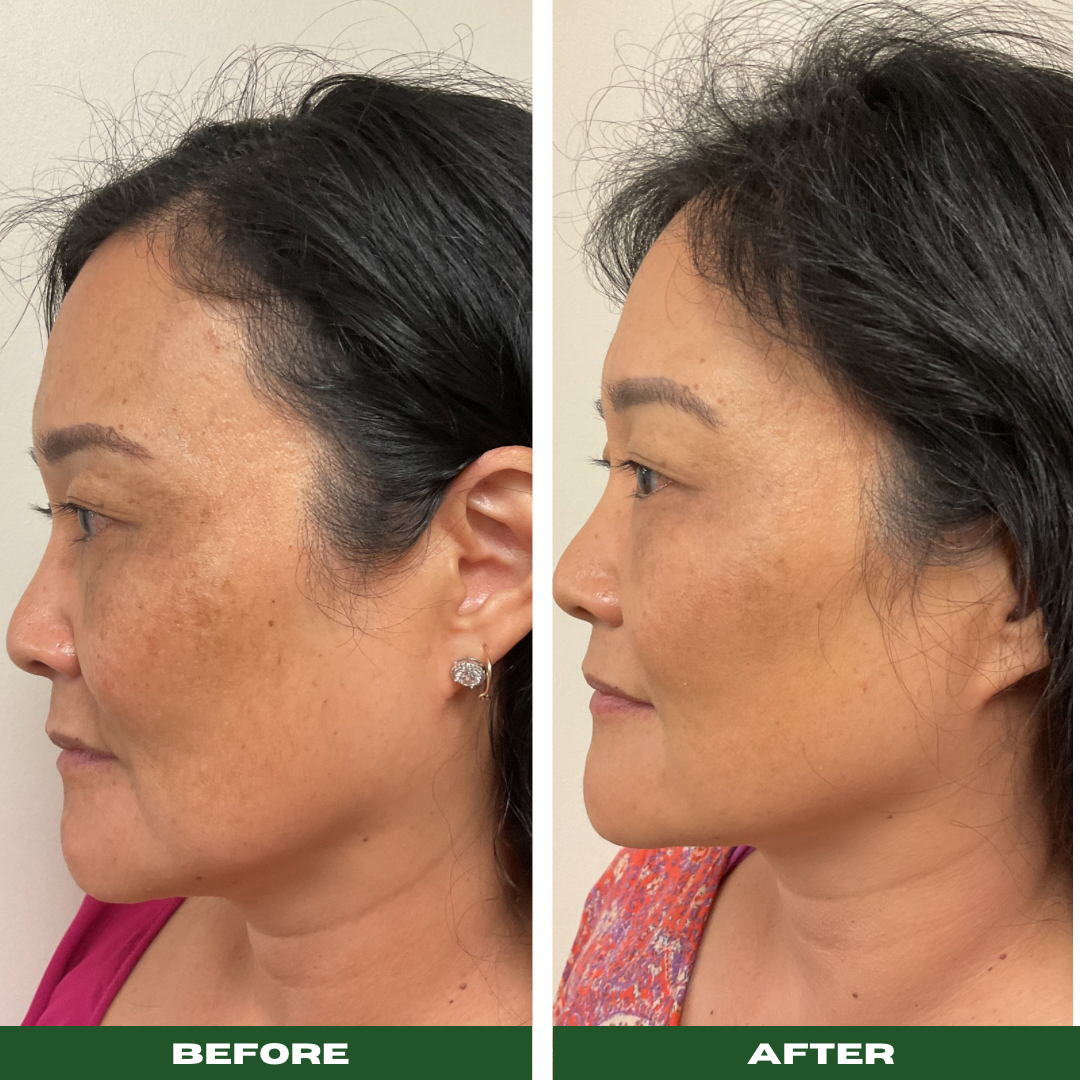 Chemical Peels