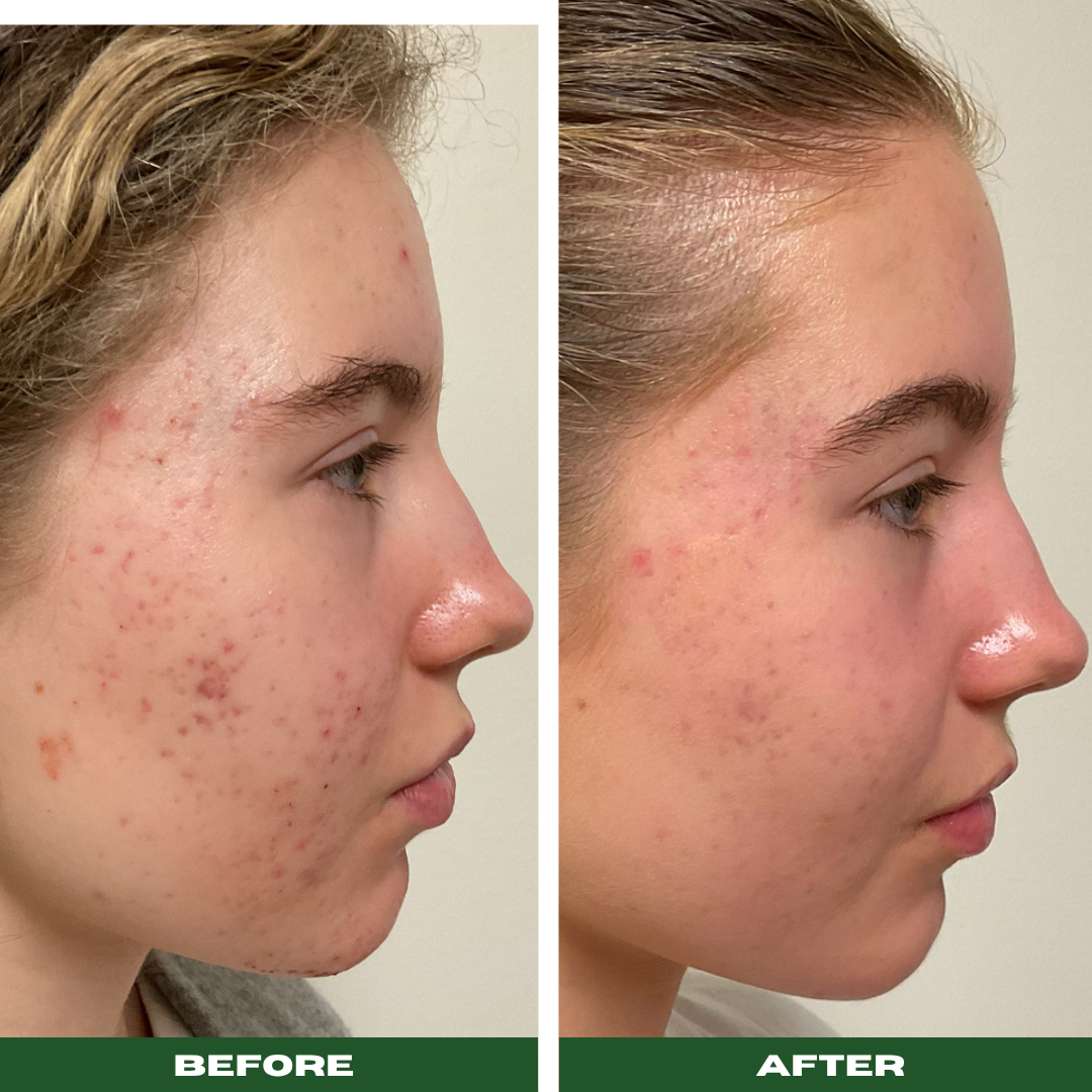 Acne Facial