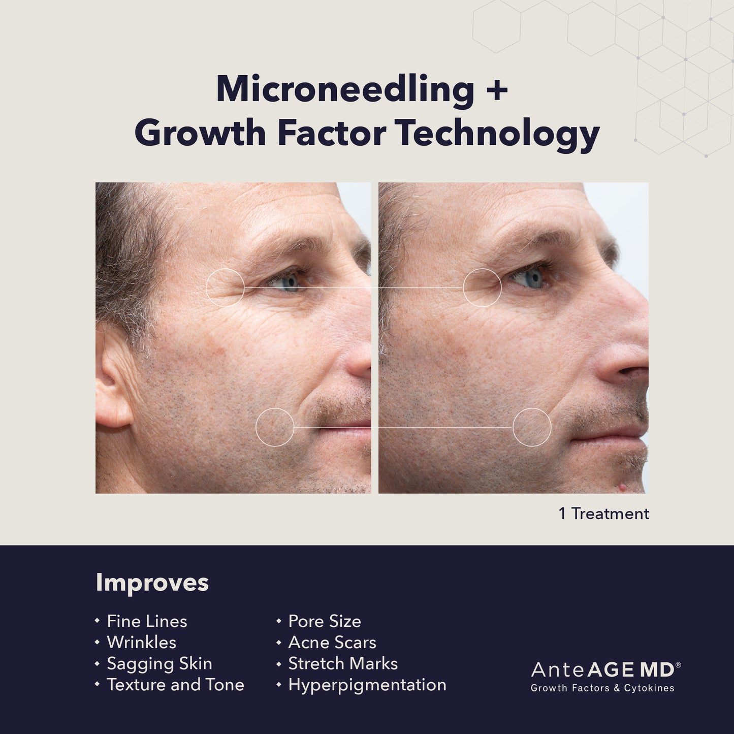Microneedling with AnteAGE