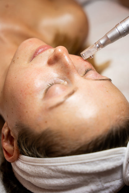 Microneedling with AnteAGE