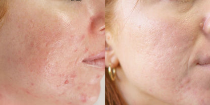 Microneedling with AnteAGE