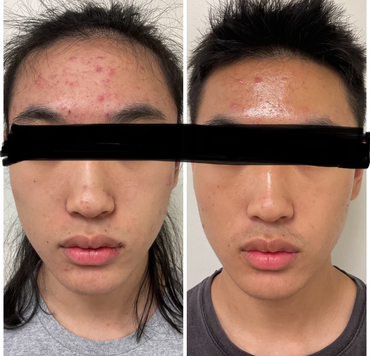 Acne Facial