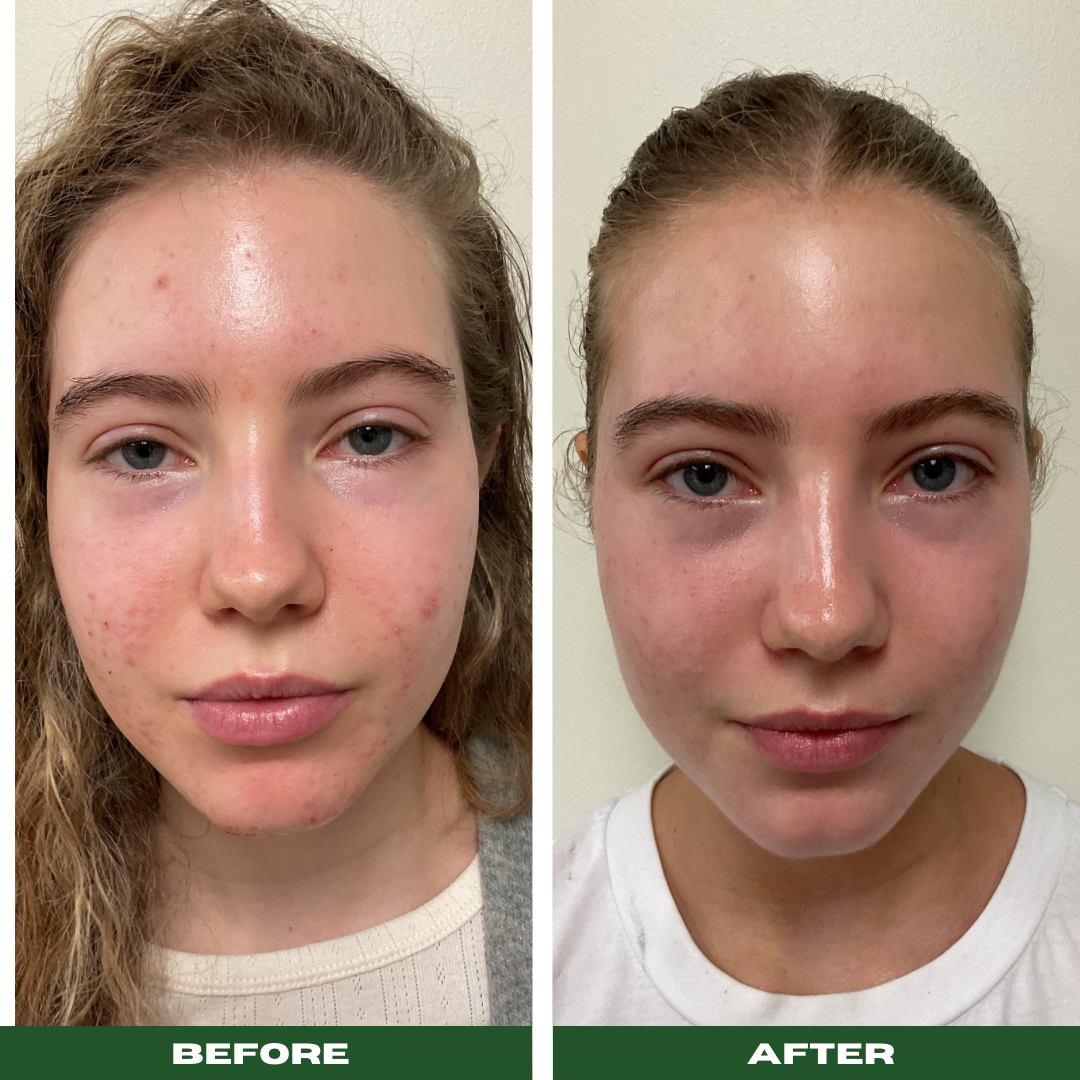 Acne Facial